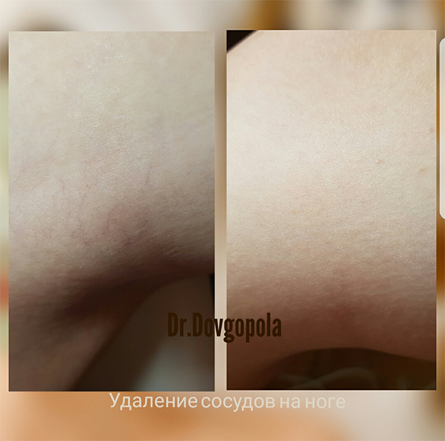 laser derm